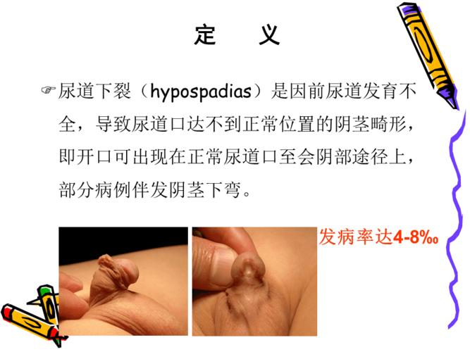 尿道下裂.ppt