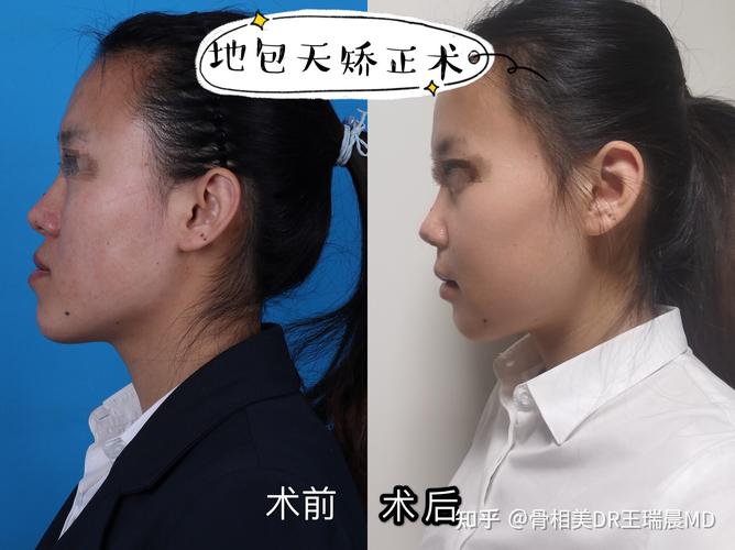 我是骨性地包天,今年十九岁,初中被男生嘲笑,一想到不