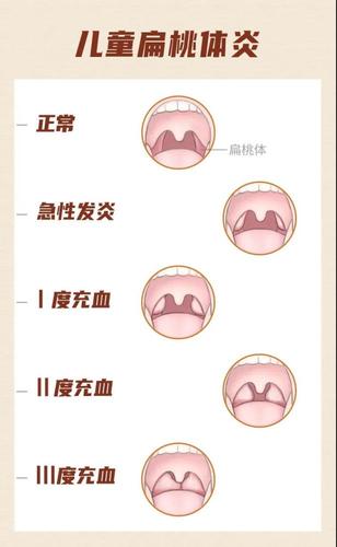 为什么扁桃体总是发炎?反复发作能不能切?你想知道的都在这里