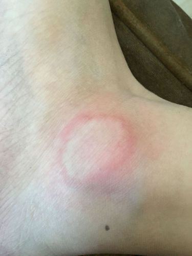 我的脚踝处长了一圈红色的小疙瘩特别痒痒关键是长了一个圆圈以前也长