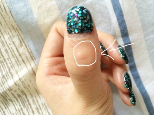 左手大拇指关节突然发现有一粒肿块,不按没