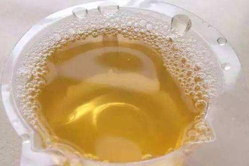 一般来讲,尿液是清澈或者淡黄色的,但是如果发现自己的尿液颜色很重