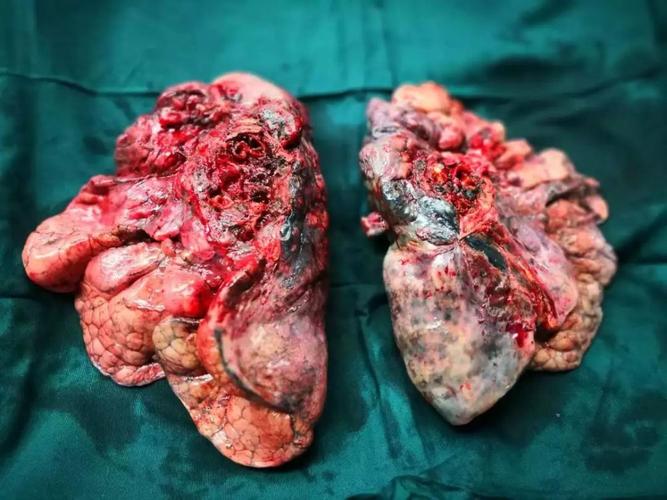 肺腺癌有靶向药fda批准过几个单抗单抗