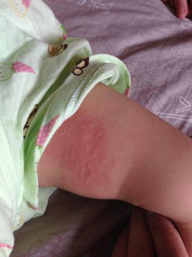 宝宝一岁三个月,今早突然大腿内侧出现红,而且有颗粒