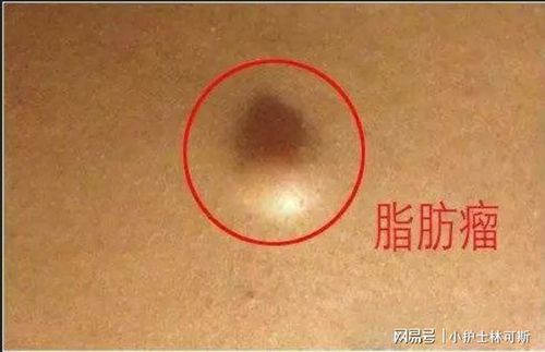 脂肪瘤是什么原因导致的如何预防