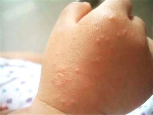 "沙"么鬼,玩沙子也能玩出皮炎