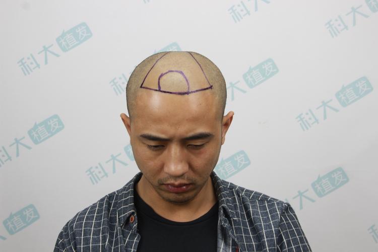 植发【头顶加密 种植发际线】 项目分类:植发养发 植发 种植发际线