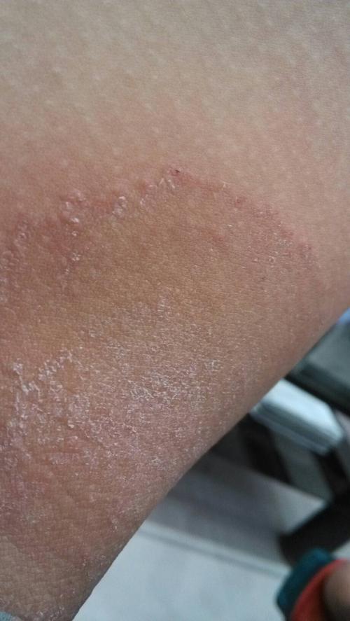 我大腿内测有小红片,晚上特别痒,经常想挠痒痒这是属于什么情况?