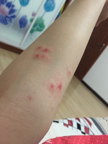 过敏皮肤科   我有更好的答案