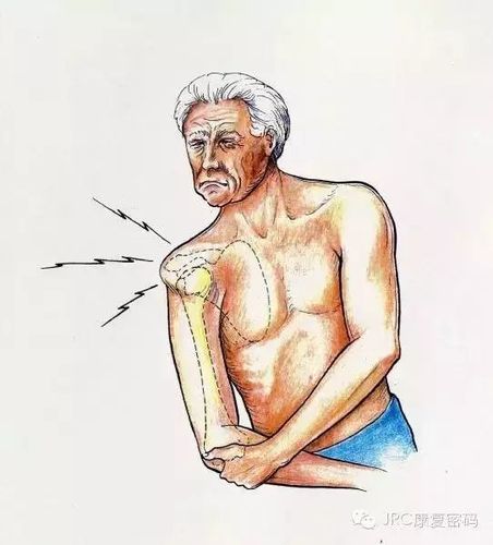 脑卒中偏瘫患者肩关节半脱位康复宣教