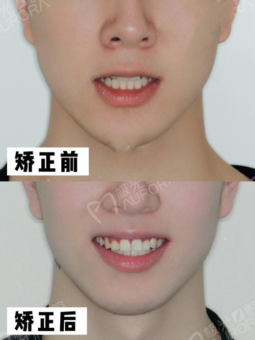 案例公开咬合紊乱牙不齐1年半结束