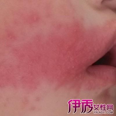 新生儿红斑图片欣赏 其6大护理要点介绍