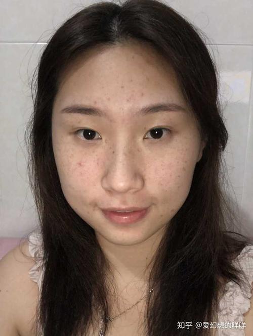 雀斑女孩
