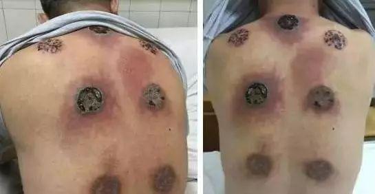 加之夏天气温高,雨水多,湿度大,人体内很容易湿气积聚,此季节拔罐