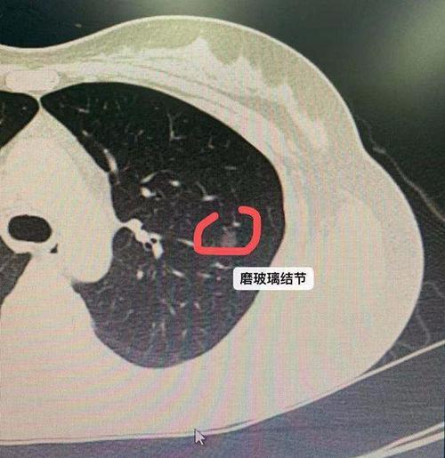 恶性的肺结节都有哪些特征