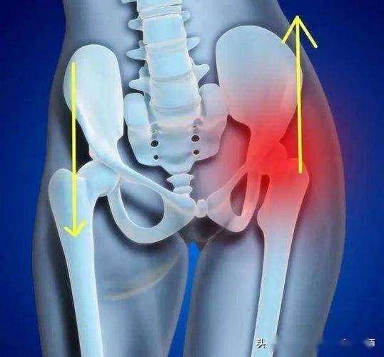 骨盆歪了吗腰痛和腿疼罪魁祸首在这儿