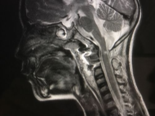 手术后复查的颈椎mr片,提示陷入枕骨大孔的枢椎齿状突已经下拉复位