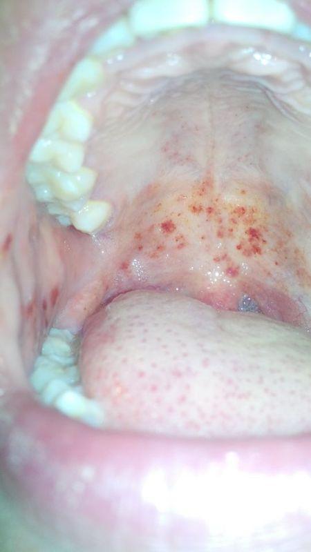 口腔内部有红斑求救很着急!