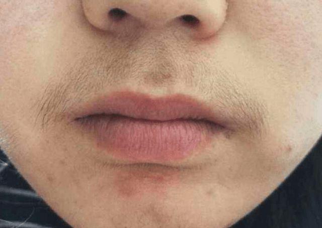 唇毛与什么有关?该如何应对?