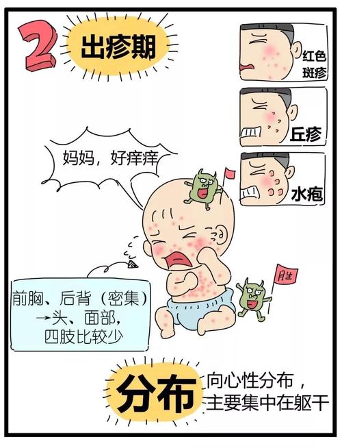 战"痘"攻略——水痘的预防宣传