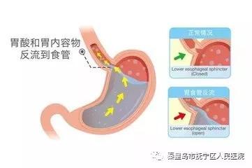 胃食管反流病宣传周什么是胃食管反流病经常恶心干呕你更要看过来