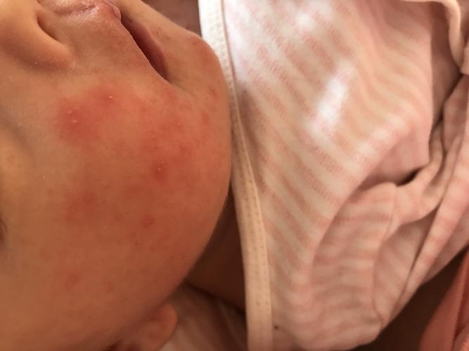 女宝宝 湿疹还是新生儿痤疮 红色疙瘩上带小白点 脖子 后背