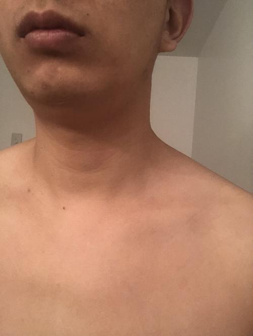 下颚两侧淋巴结明显大,下垂下来,已经有三五年了,去看