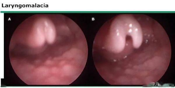 喉软化,不是出生就有,也不一定是喉软骨的软化!