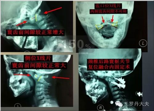 一例寰枢关节半脱位的病例报道(转自网络)
