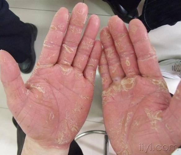 被诊断为皲裂性湿疹,银屑病,毛发红糠疹,进行性对称性红斑角皮症等