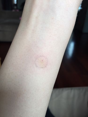 肺结核皮试72小时候的反应,无硬结,刚开始有红晕,但红晕慢慢在消除.