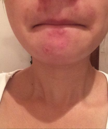 全身瘙痒伴有银屑和溢出物早期头皮发痒满满到脸部现在是