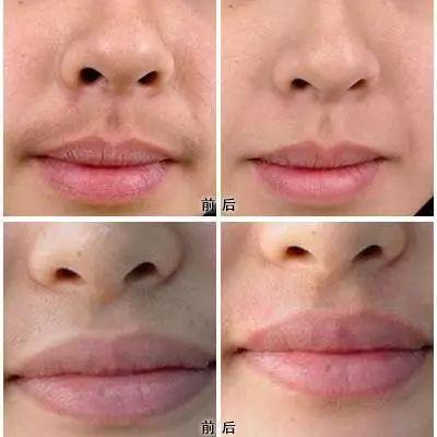 脱唇毛也能像脱腋毛那样,脱完就不长了?