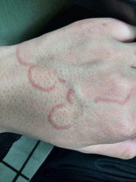 我的病到底是荨麻疹还是离心性环状红斑?属于哪科?怎么治?(见图)