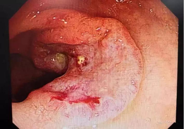 距肛门17-20cm处φ3cm之溃疡性病变虽然这不是我们常说的能够通过