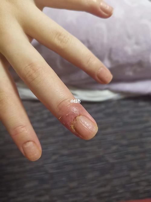 湿疹(汗疱疹 角质剥脱症)一个月的恢复情况～完美 指甲是因为之前发