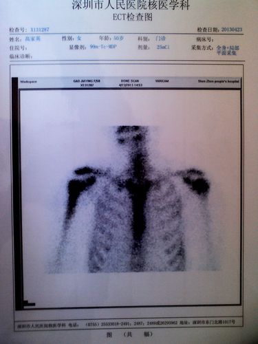 在线等——做全身骨扫描说是右侧肱骨上段左侧股骨头局限性骨代谢增高