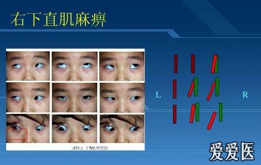 眼科复视相检查