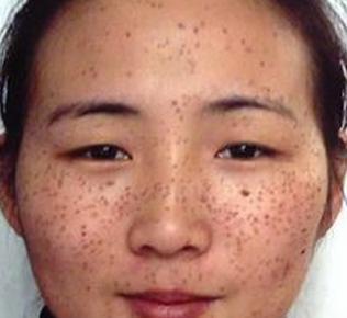 脸上长点痘阿斑的,都急得不得了,甚至很多mm因为脸上有雀斑后,就想