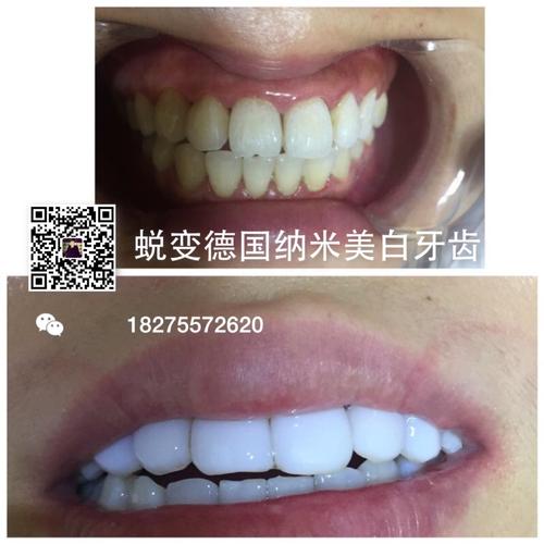 其它 我的美篇 写美篇此技术不是牙齿漂白,也不是洗白,而是一种美容