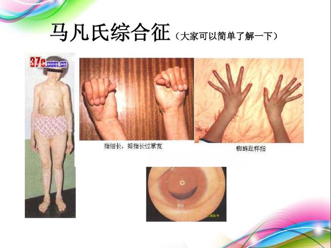 马凡氏综合征(大家可以简单了解一下)