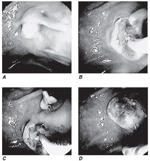 图文并茂胃肠道疾病的内镜诊断内镜诊断医脉通
