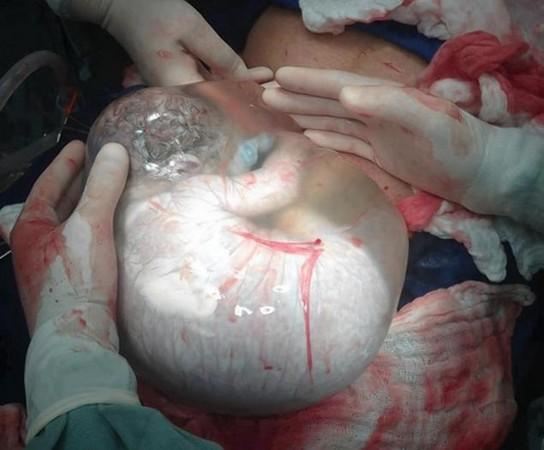 胎儿包覆「完好羊水囊」降生.(图/取自纽约每日新闻