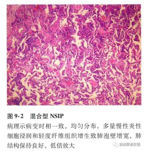 特发性间质性肺炎病理,影像及临床解析——丁啸