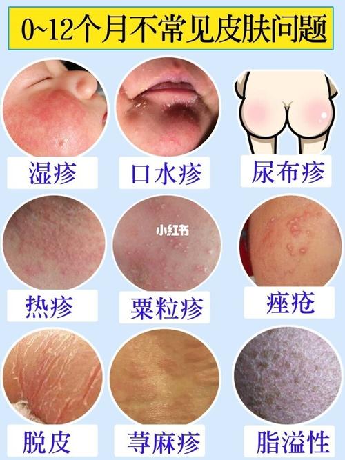 新手爸妈必看15你会遇到的那些新生儿常见皮_新生儿
