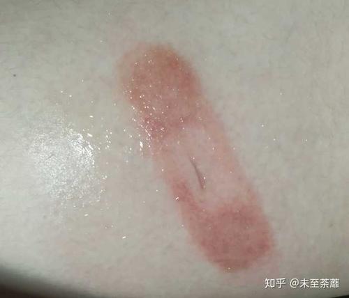 之前从来没有创可贴过敏.