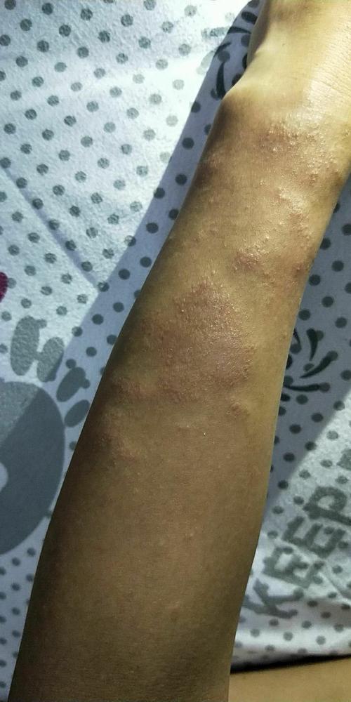 日光疹可以治愈么?