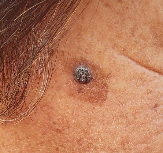 老年斑上长了一个痣,有问题么?已经很大了