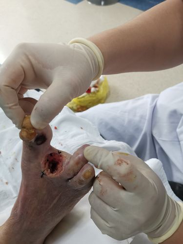 9月28日局麻行第二趾截趾清创,对症换药,术后一周恢复尚可,疼痛减轻