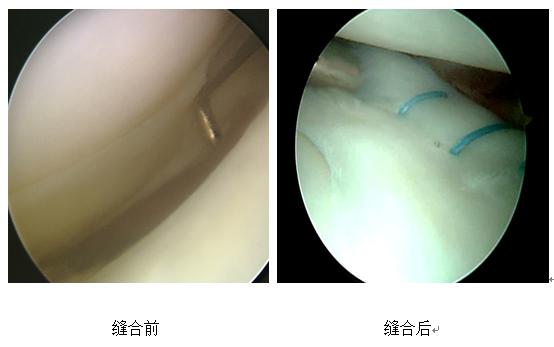 全内缝合技术治疗半月板损伤